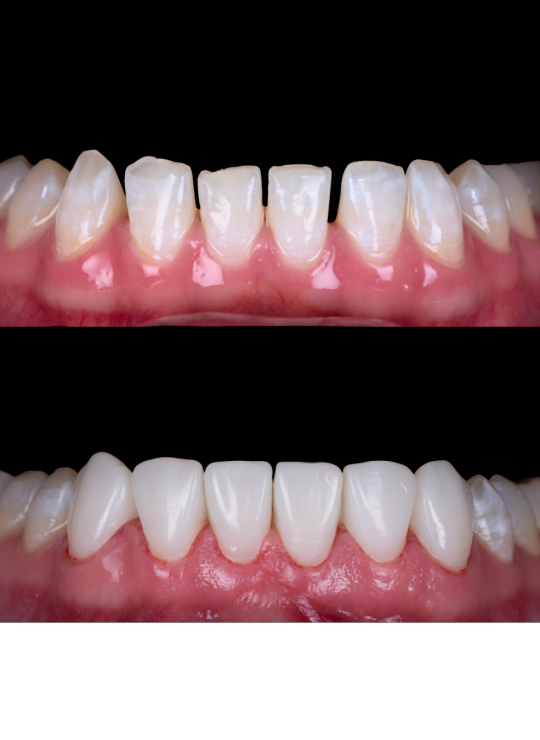 composite bonding course (1)