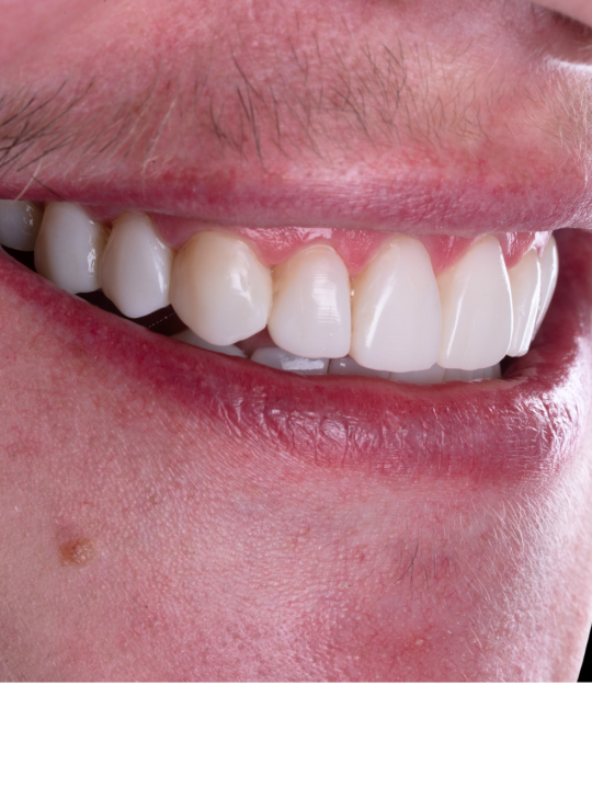 composite bonding course (10)