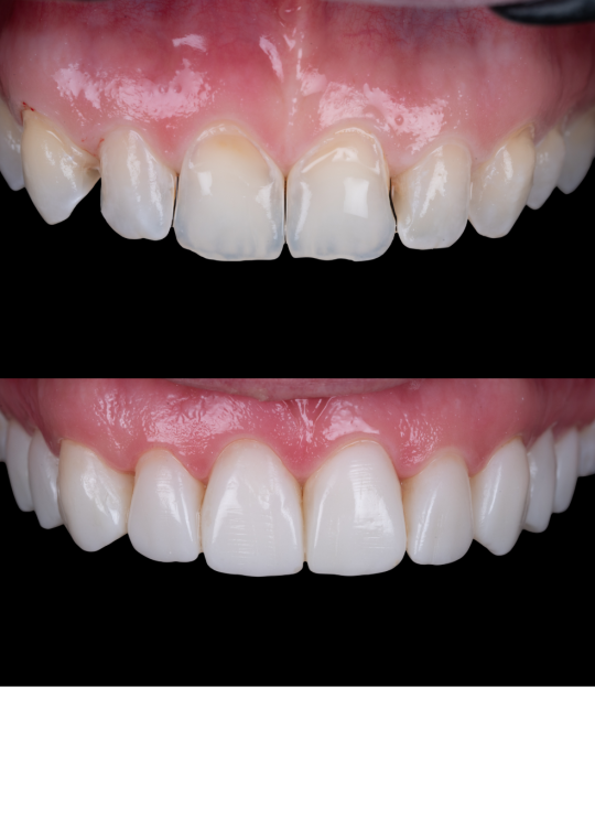 composite bonding course (11)