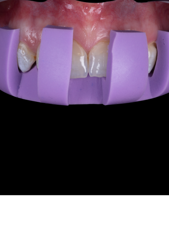 composite bonding course (7)