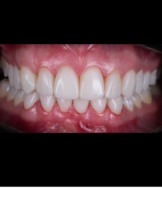 composite bonding course (9)