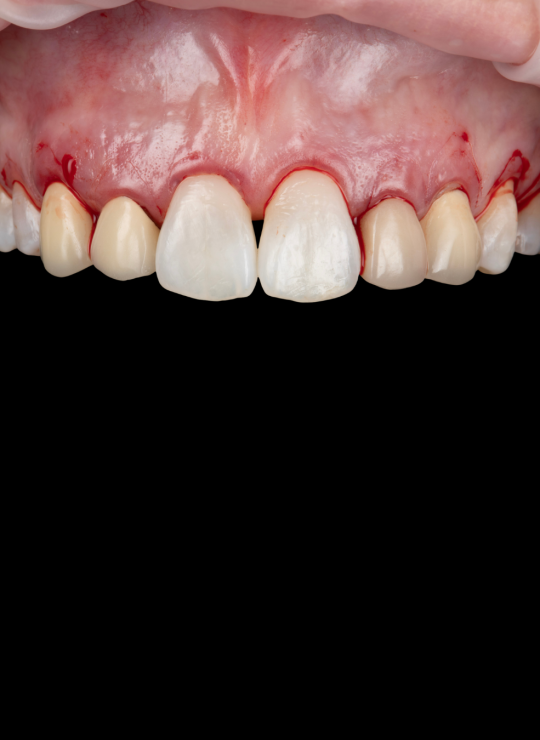 crown lenghtening course uk london periodontology course (1)