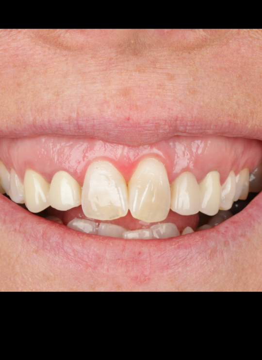 crown lenghtening course uk london periodontology course (10)