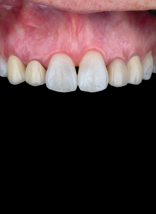 crown lenghtening course uk london periodontology course (11)