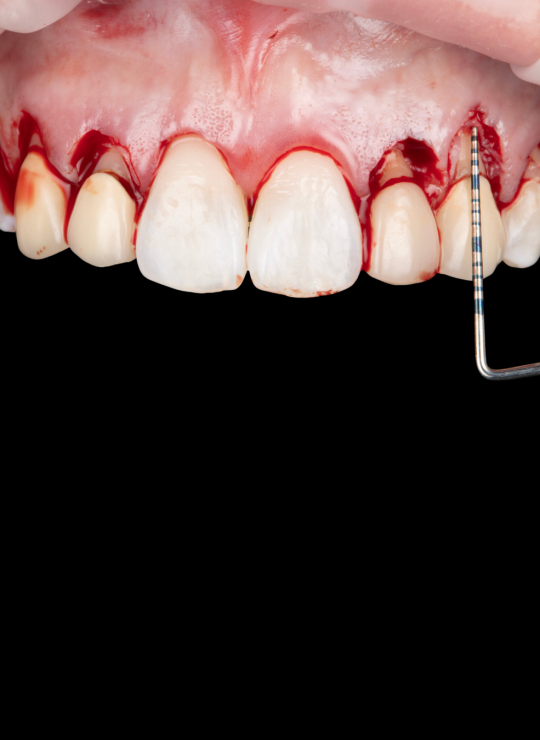 crown lenghtening course uk london periodontology course (2)