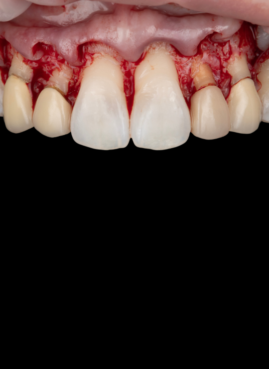 crown lenghtening course uk london periodontology course (3)