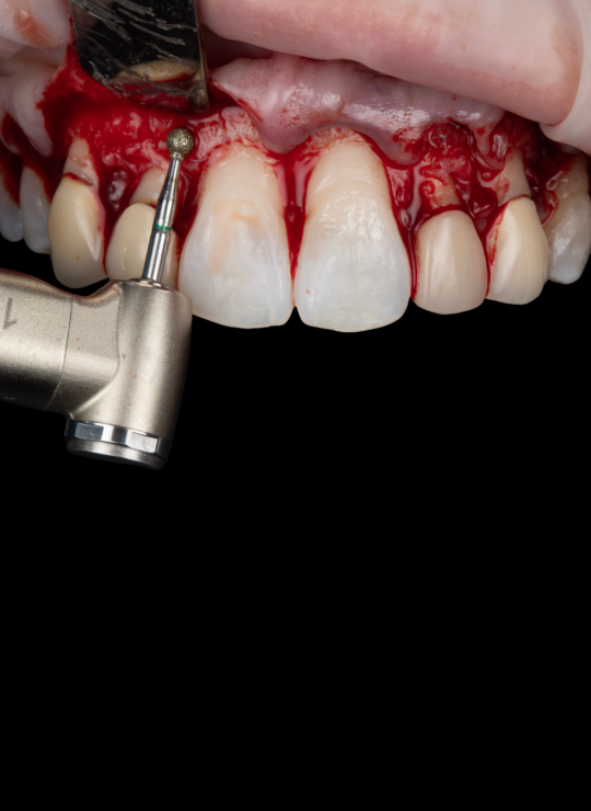 crown lenghtening course uk london periodontology course (4)