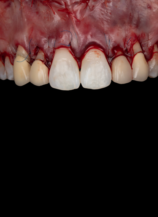 crown lenghtening course uk london periodontology course (5)