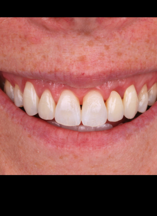 crown lenghtening course uk london periodontology course (6)