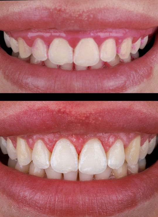 crown lenghtening course uk london periodontology course (7)