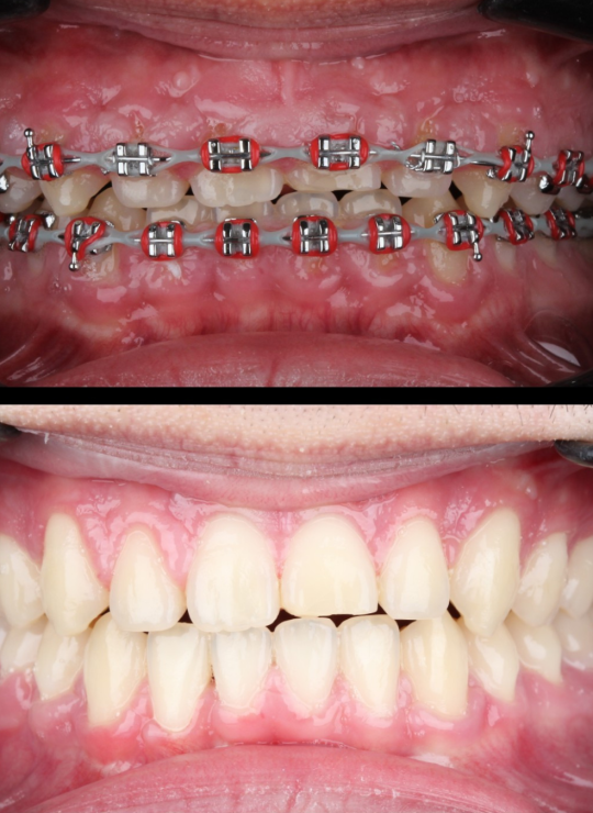 crown lenghtening course uk london periodontology course (8)