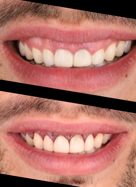 crown lenghtening course uk london periodontology course (9)